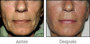fotos antes después sculptra